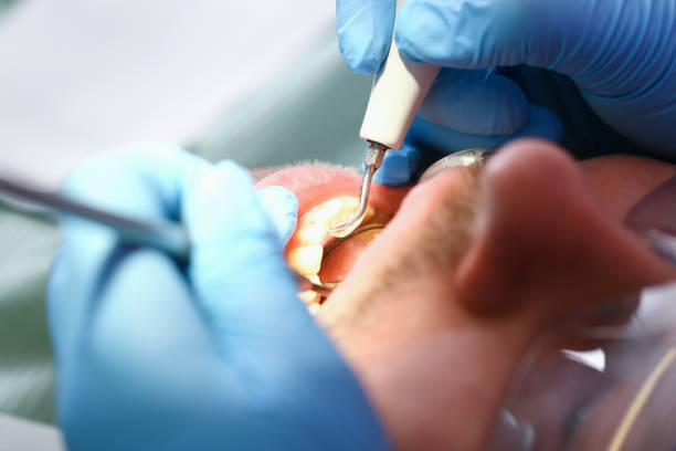 Best Emergency Treatment for Oral Infections in Logansport, IN
